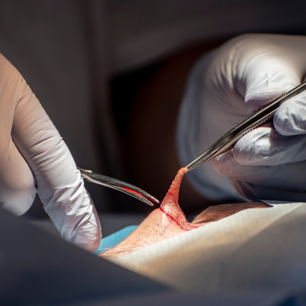 Cancer surgery